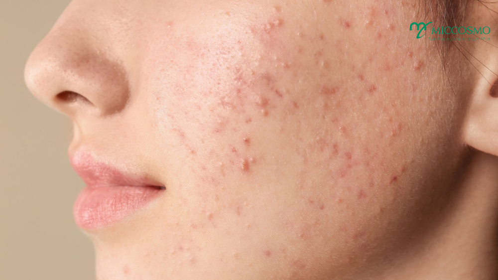 niacinamide-trong-my-pham5.png