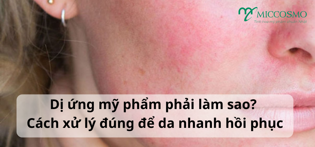Dị ứng mỹ phẩm phải làm sao? Cách xử lý đúng để da nhanh hồi phục