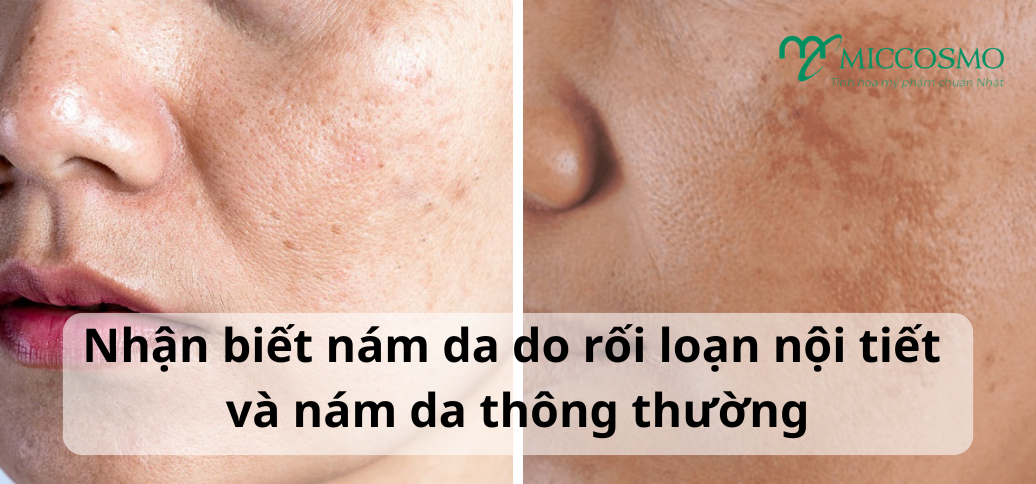Nhận biết nám da do rối loạn nội tiết và nám da thông thường: Dấu hiệu nhận biết và hướng cải thiện