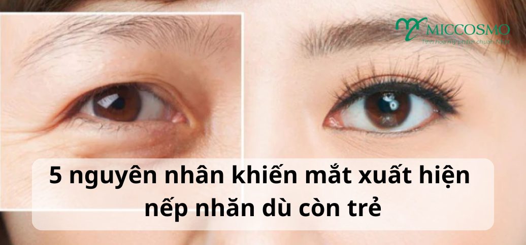 5 nguyên nhân khiến mắt xuất hiện nếp nhăn dù còn trẻ
