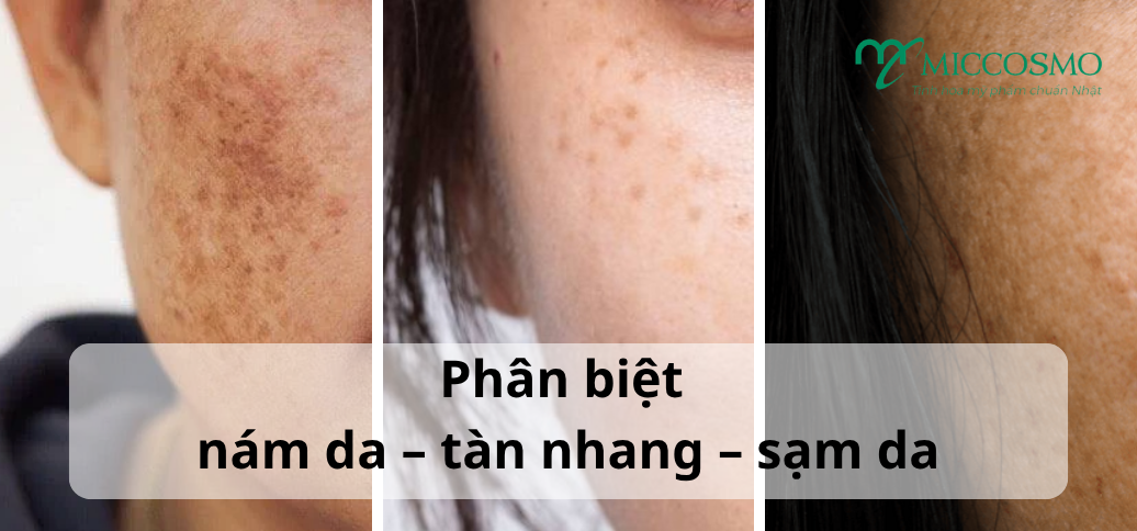Phân biệt nám da, tàn nhang và sạm da để cải thiện đúng cách