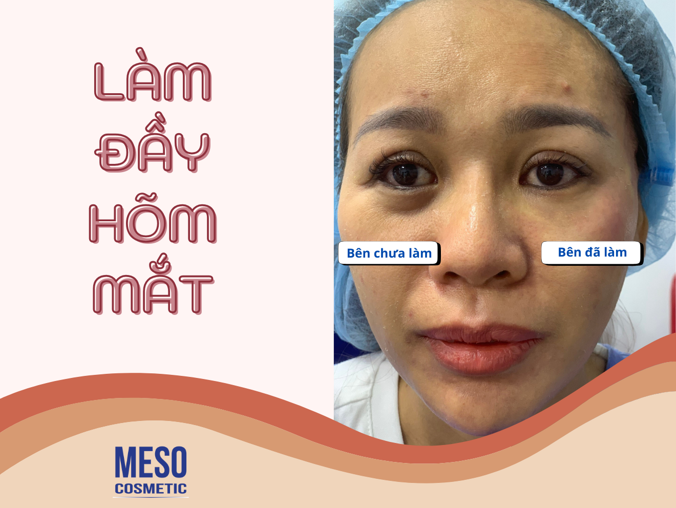 Khử Thâm & Làm Đầy Hõm Mắt – Trẻ Hóa Đôi Mắt, Xóa Quầng Thâm