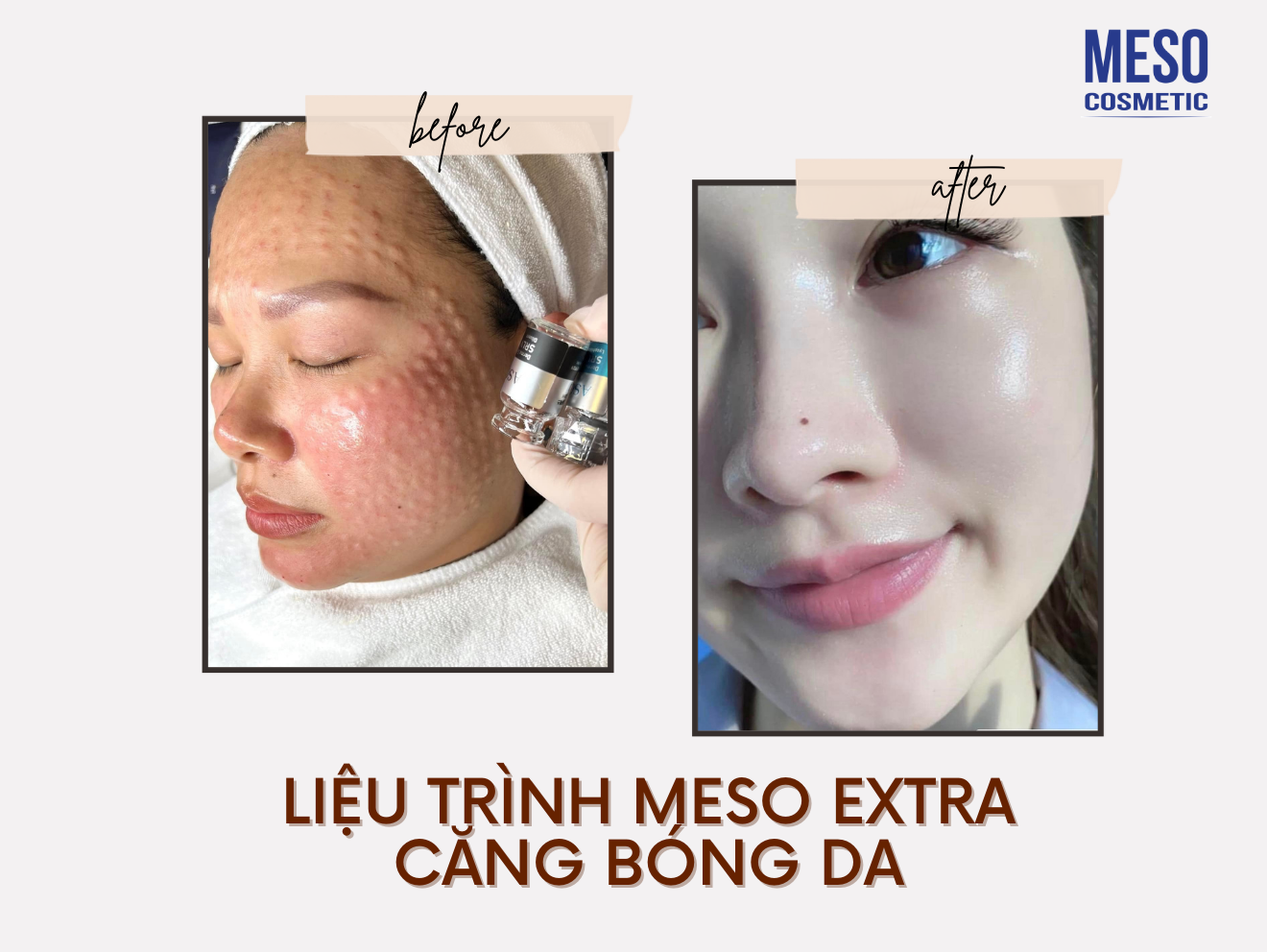 Meso trẻ hoá, căng bóng da, trị nám