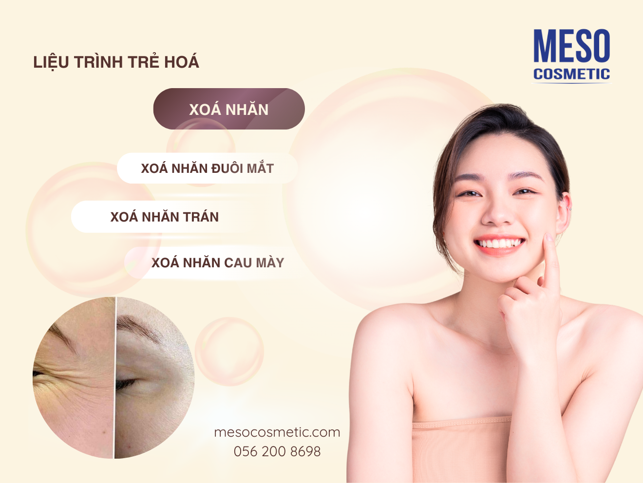 Trẻ hoá, xoá nhăn vùng trán, đuôi mắt