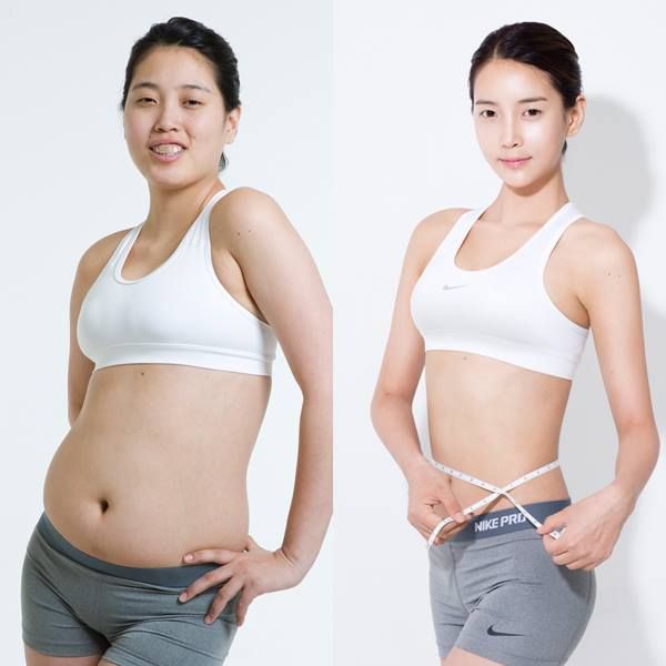 Cách chăm sóc sau hút mỡ nhanh hồi phục