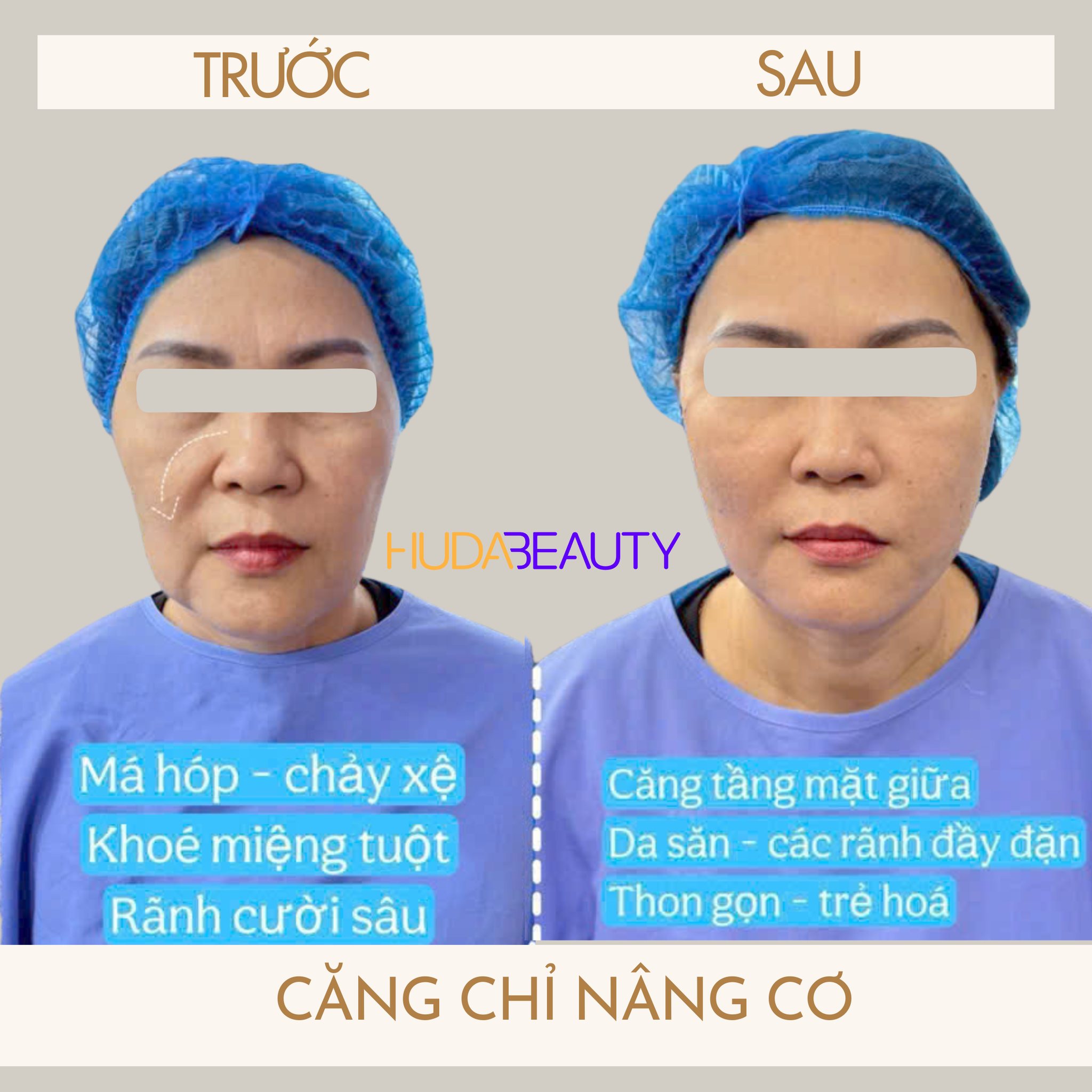 Căng chỉ da mặt có thực sự giúp nâng cơ như quảng cáo