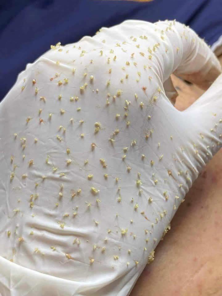 Có Nên Lấy Nhân Mụn Định Kỳ Hàng Tháng?