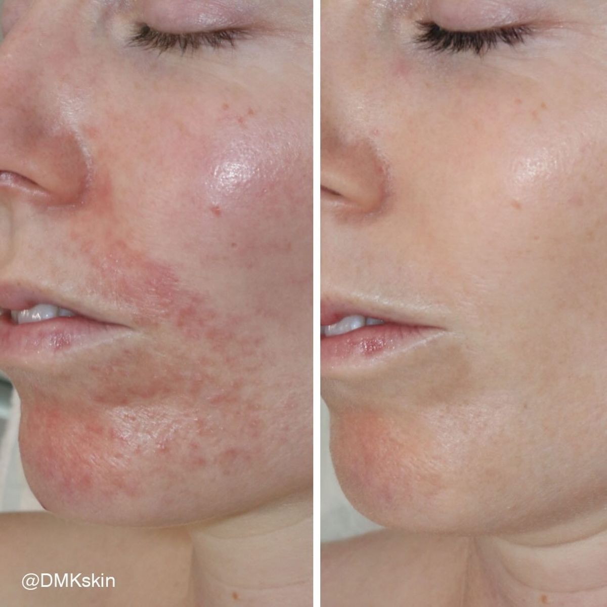 Da Nhiễm Corticoid Có Cứu Được Không? Lộ Trình Phục Hồi Chuẩn Y Khoa