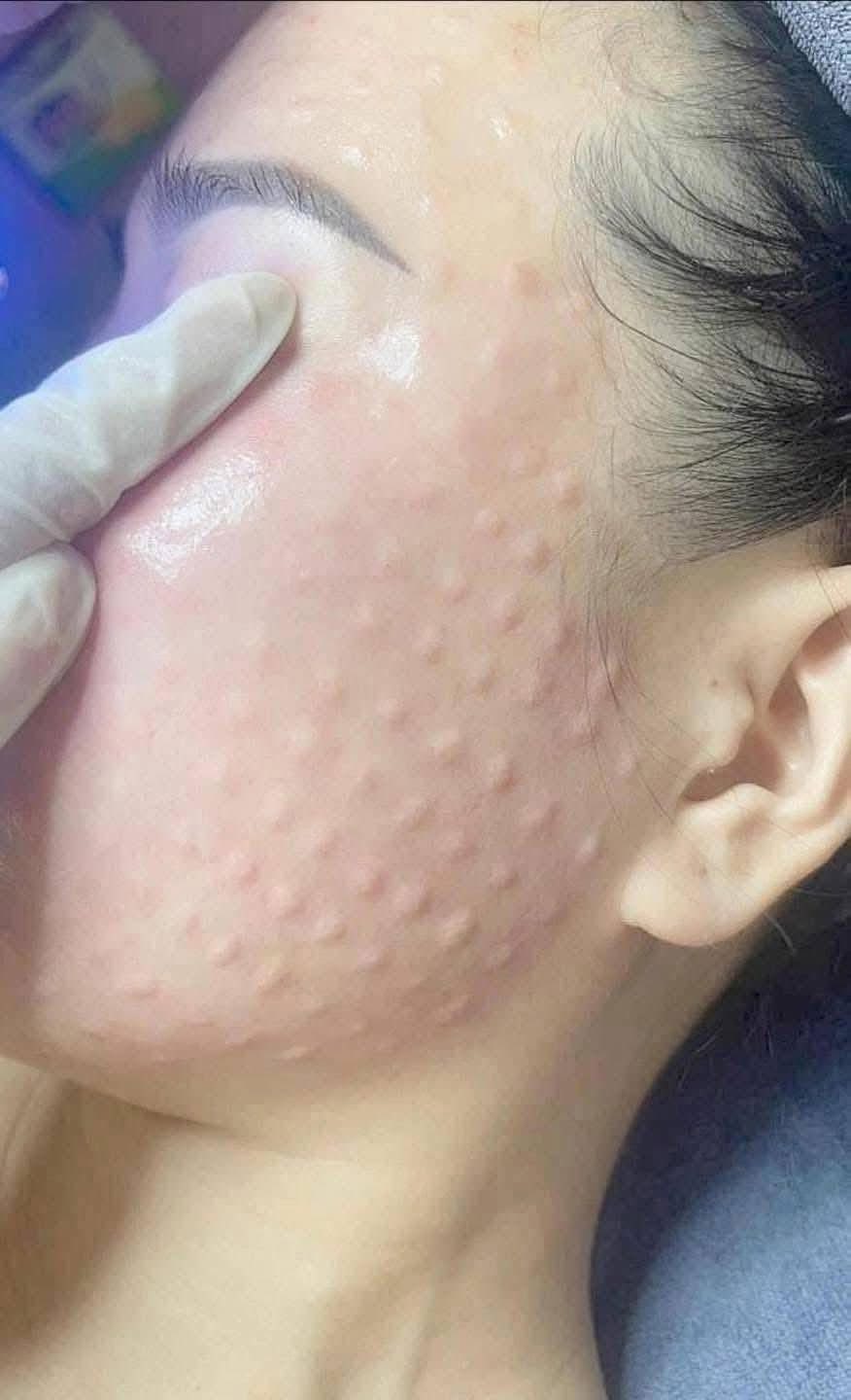 Da Tổn Thương Sau Laser, Peel: Meso Phục Hồi Có Cần Thiết?