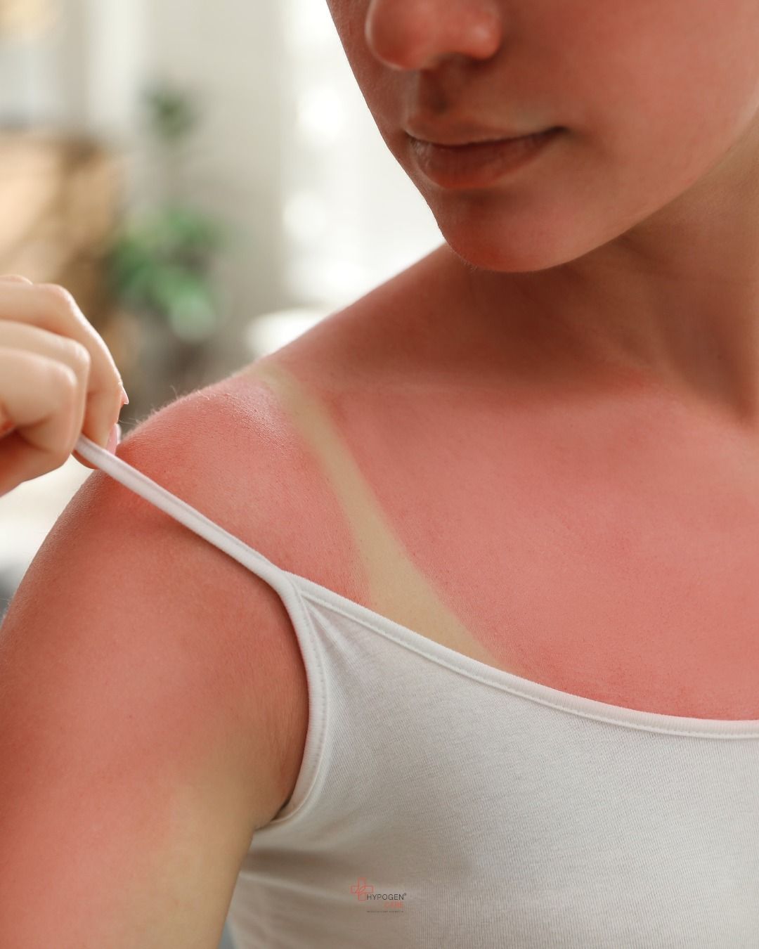 Da bị đỏ rát, cháy nắng? 15 phút