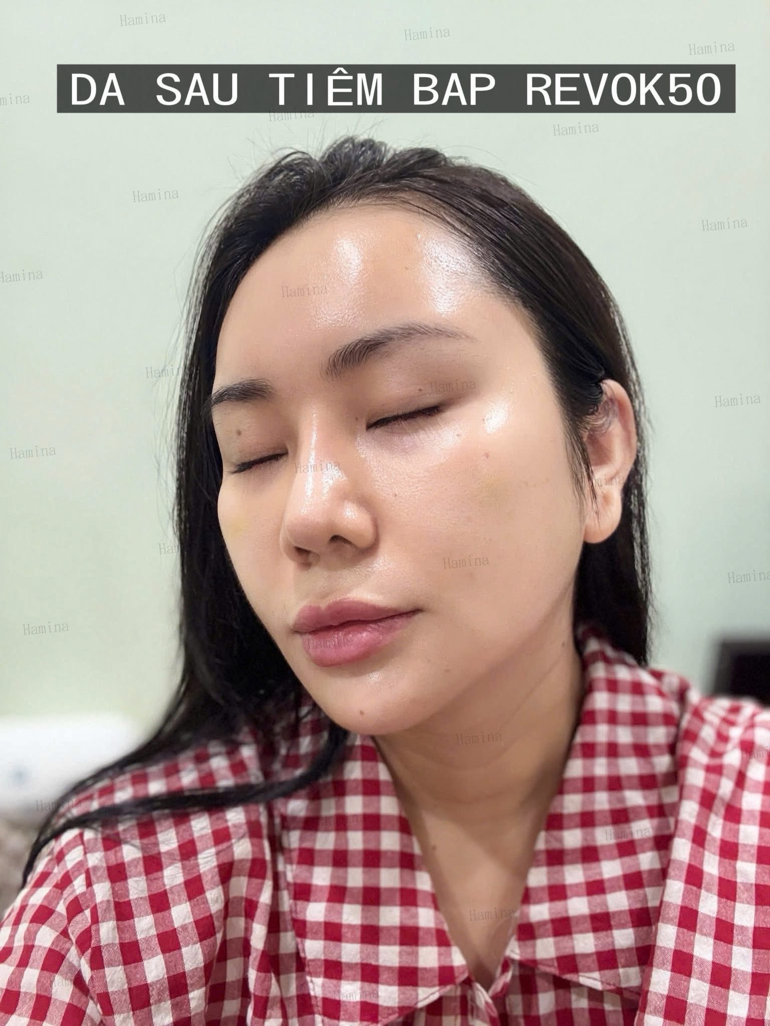 Dịch Vụ Tiêm BAP Trẻ Hóa Da – Phục Hồi, Cấp Ẩm, Cải Thiện Chất Da