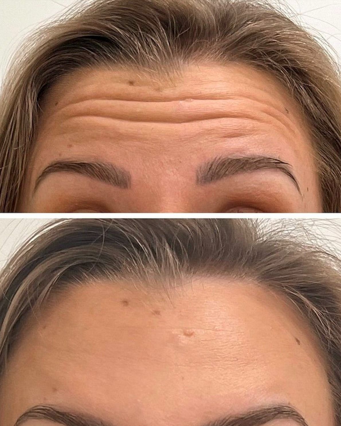 Hậu Quả Khi Tiêm Botox Không Rõ Nguồn Gốc