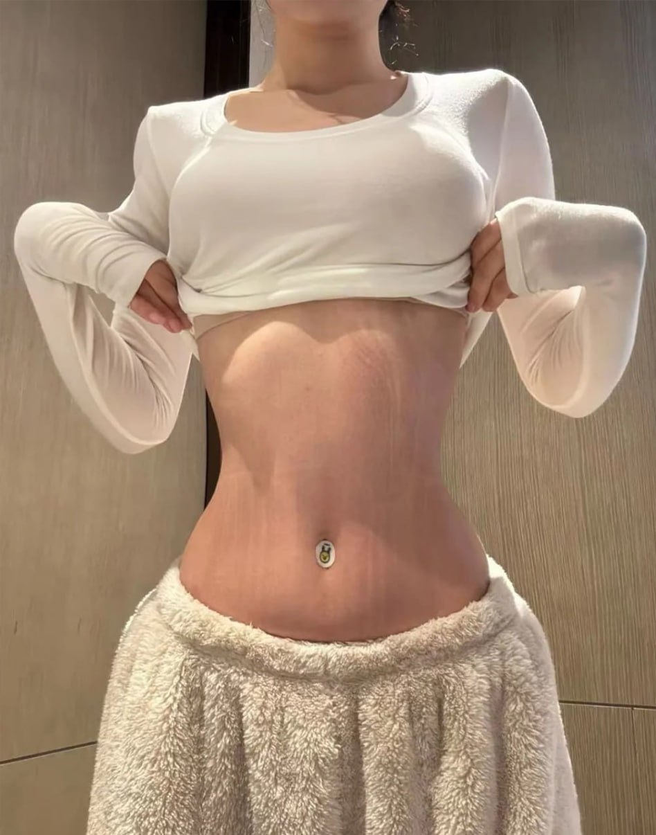Hút mỡ có để lại sẹo không?