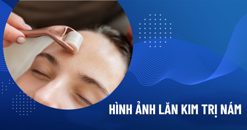 Lan-kim-tri-nam-tan-nhang-Giai-phap-chuyen-sau-hieu-qua-nhanh_Lăn kim trẻ hoá, trị nám-1.jpg