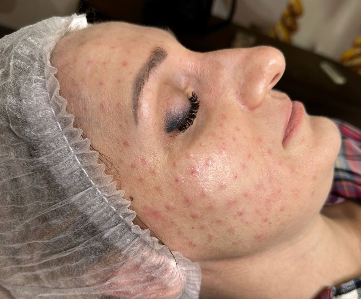 Mesotherapy Là Gì? Toàn Bộ Kiến Thức Về Tiêm Meso Trong Thẩm Mỹ Da