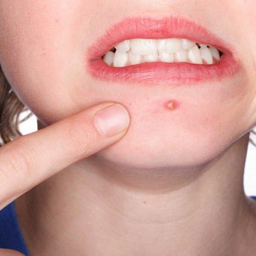 Mụn Mủ Lan Rộng – Dấu Hiệu Cảnh Báo Ổ Viêm Đang Vượt Tầm Kiểm Soát