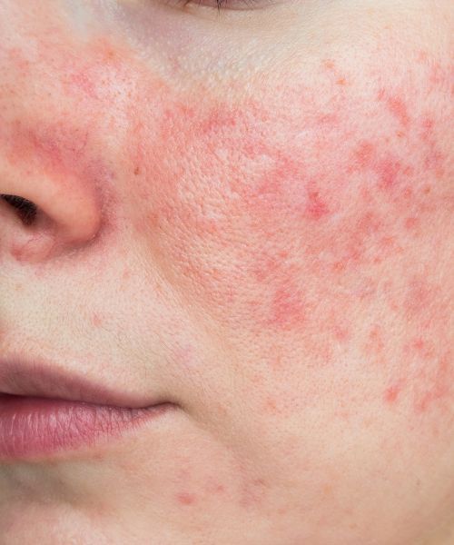 Những Dấu Hiệu Da Đang Hồi Phục Tốt Sau Lấy Mụn