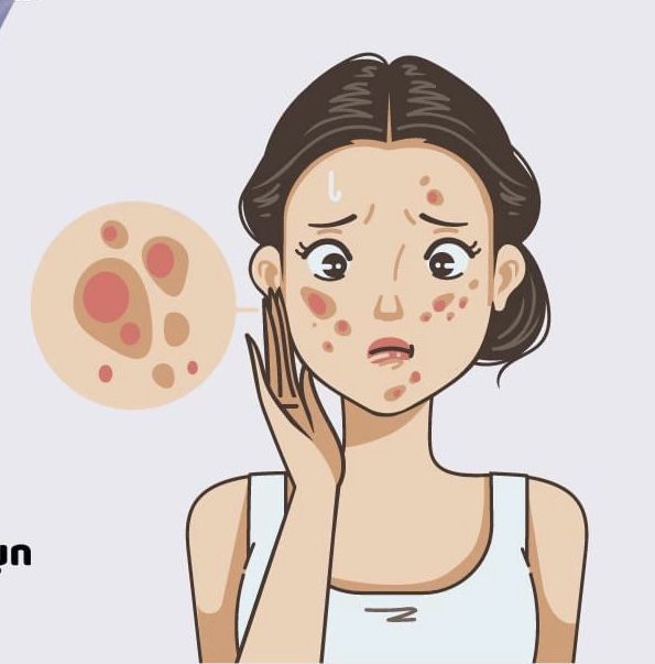 Những cách cải thiện tình trạng mụn sưng viêm ngay tại nhà