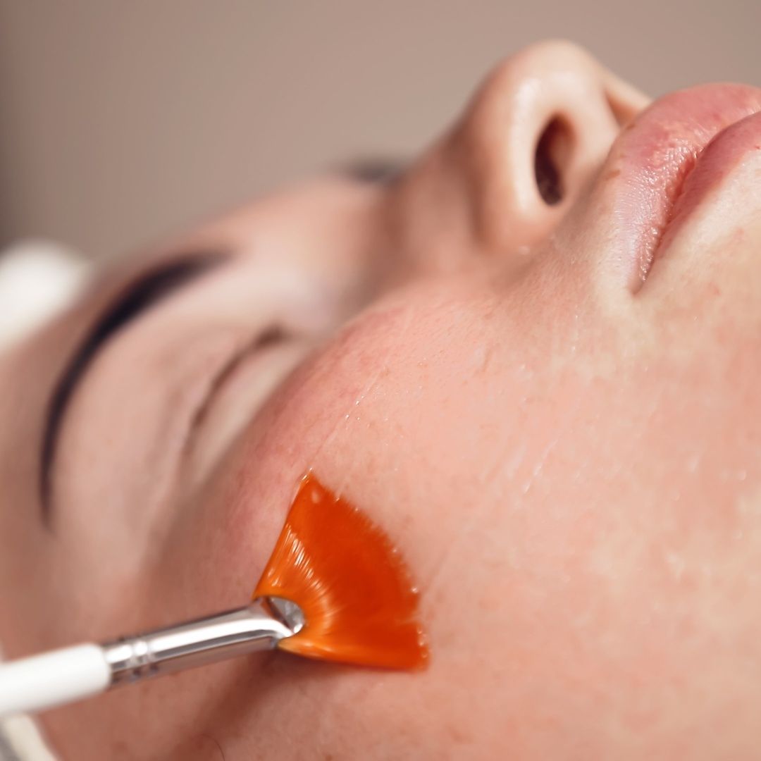 Peel Da Có Trị Được Mụn Viêm Không? Sự Thật Từ Chuyên Gia Da Liễu