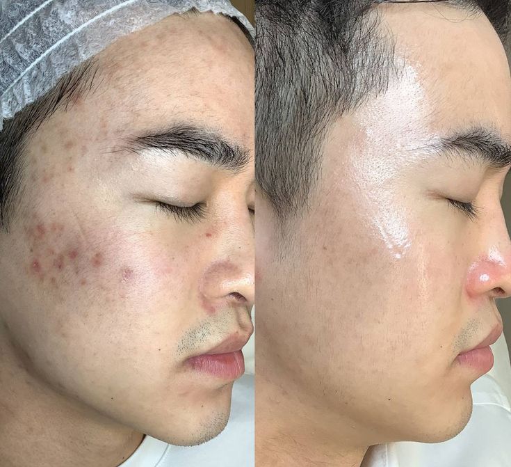 Peel-da-tai-nha-nhu-the-nao-Bi-Quyet-Tai-Tao-Lan-Da-Min-Mang-Sang-Khoe-Nhu-Spa_peel da tại nhà.jpg