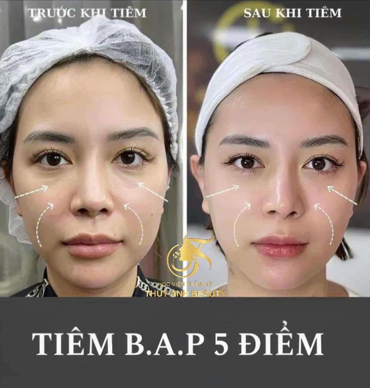 Tiem-BAP-Co-Ho-Tro-Tri-Mun-Giam-Tham-Khong--1.jpg