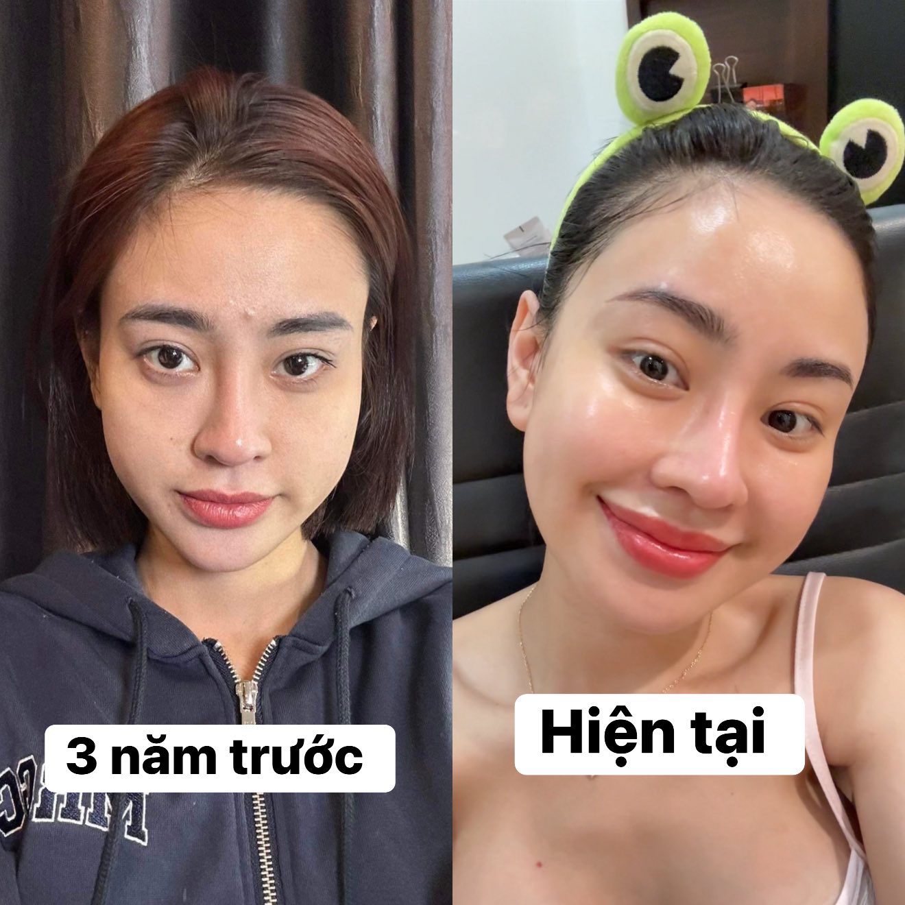Tiem-BAP-Co-Ho-Tro-Tri-Mun-Giam-Tham-Khong--2.jpg