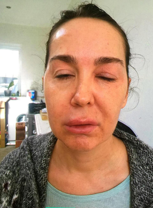 Tiem-Botox-Co-Anh-Huong-Den-Suc-Khoe-Khong--1.jpg