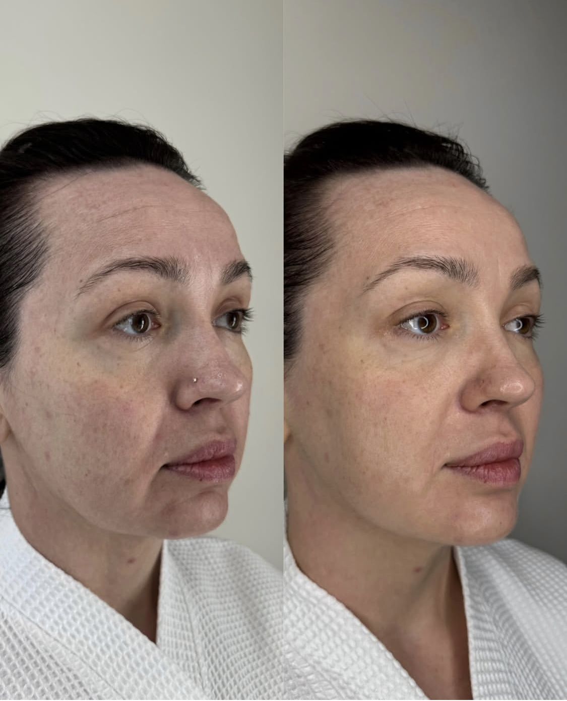 Tiem-Botox-Co-Anh-Huong-Den-Suc-Khoe-Khong--2.jpg
