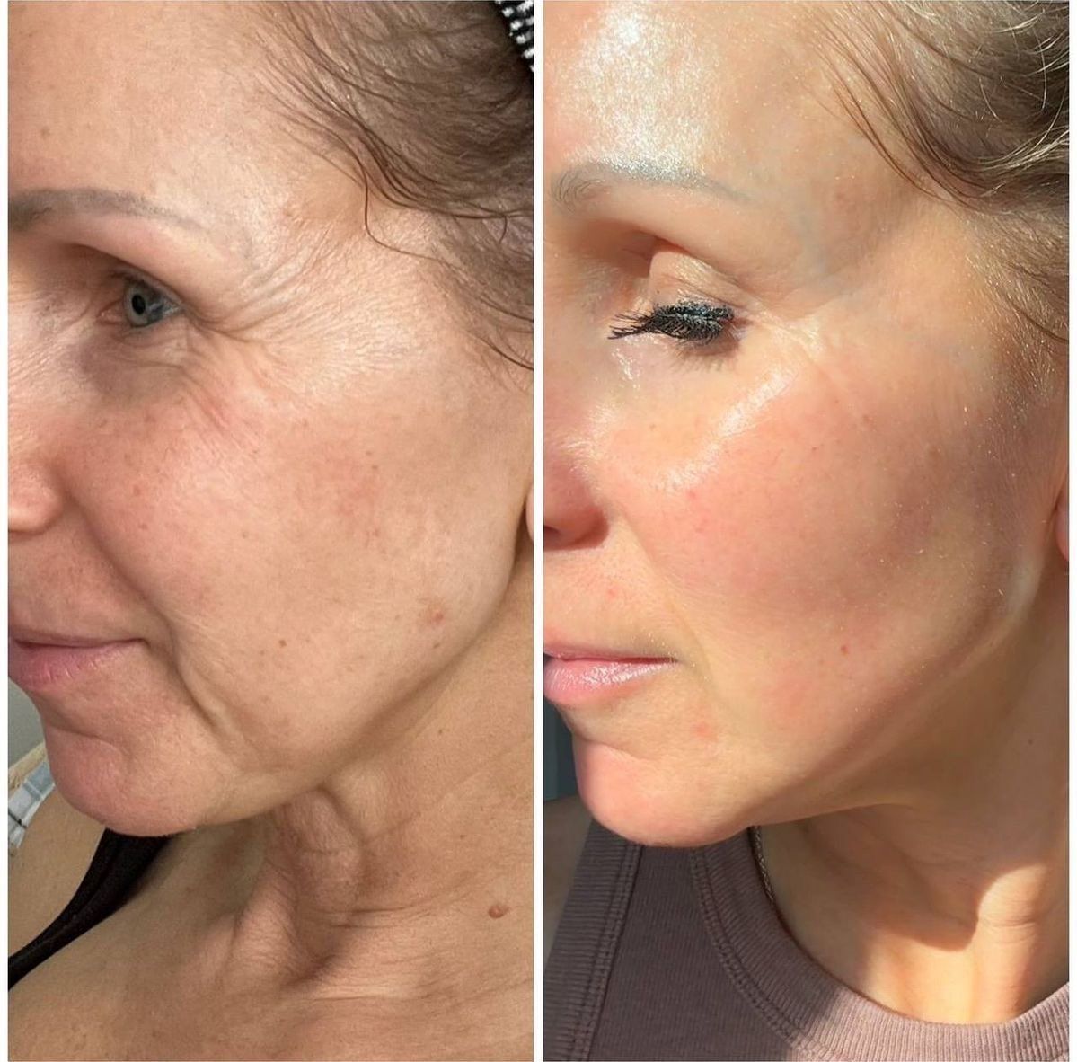 Tiêm Botox Có Ảnh Hưởng Đến Sức Khỏe Không?