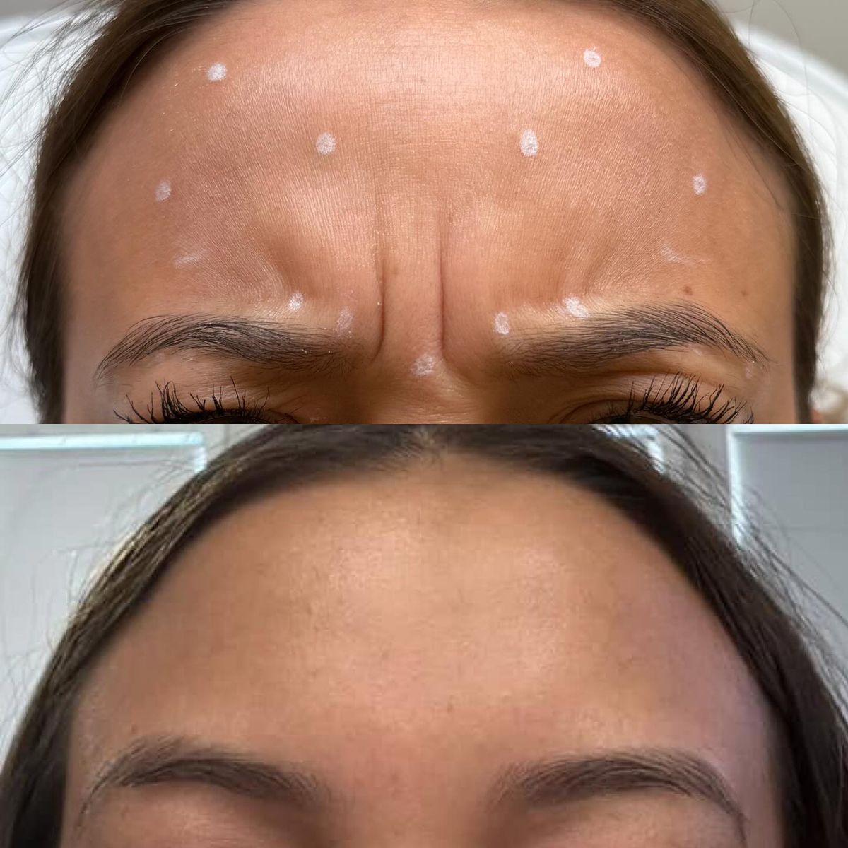 Tiem-Botox-Co-Anh-Huong-Den-Suc-Khoe-Khong-.jpg