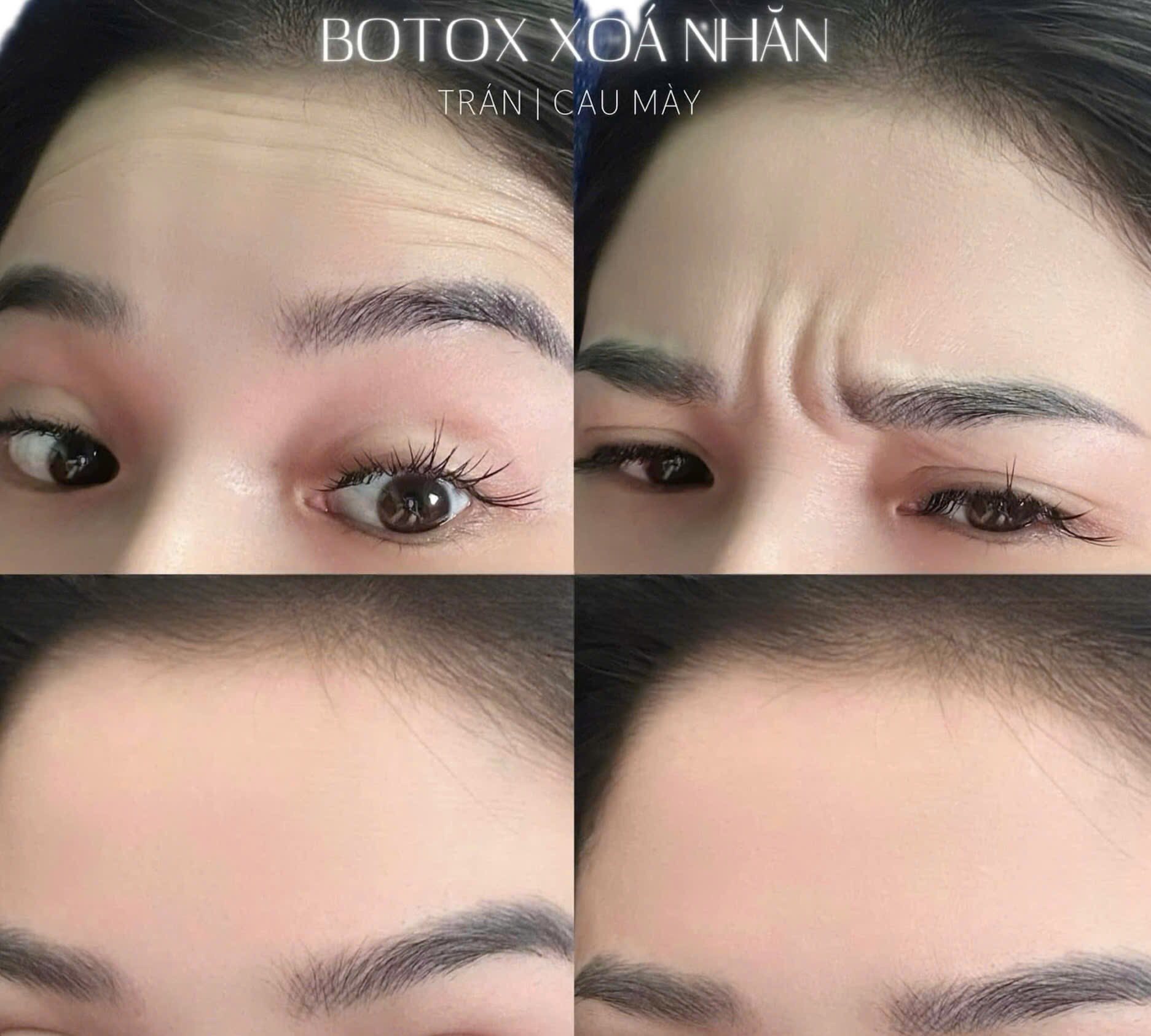 Tiêm Botox Xóa Nhăn Trán, Đuôi Mắt Có Hiệu Quả Không?