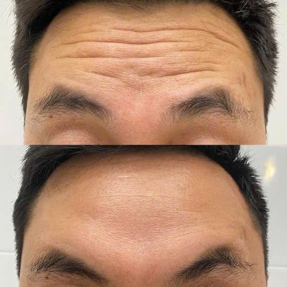 Tiem-Botox-Xoa-Nhan-Tran-Duoi-Mat-Co-Hieu-Qua-Khong--2.jpg