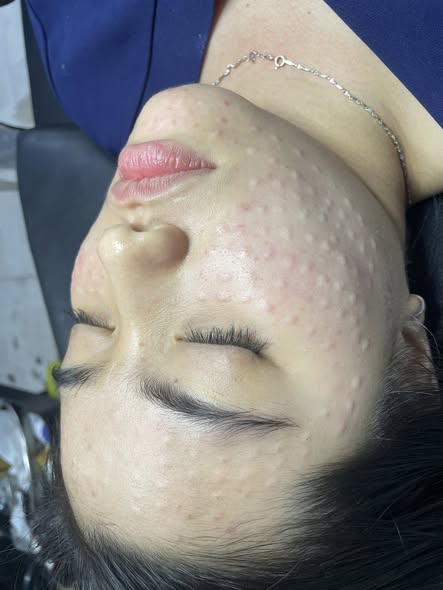 Vì Sao Có Người Làm Meso Trắng Da Không Thấy Sáng?