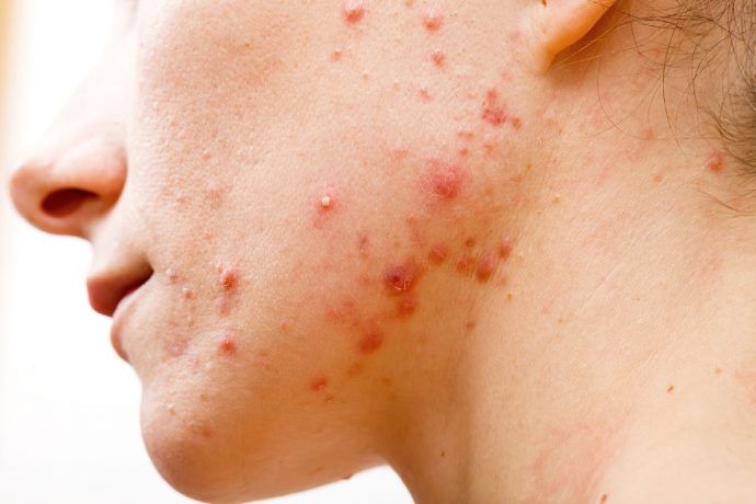 Vì sao bị mụn nội tiết? Nguyên nhân ít ai biết