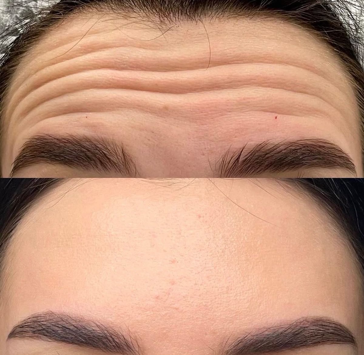 Cach-Giu-Hieu-Qua-Tiem-Botox-Xoa-Nhan-Lau-Hon.jpg