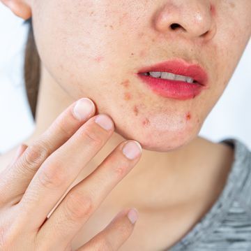 Cach-detox-co-the-giam-mun-noi-tiet-1.jpg