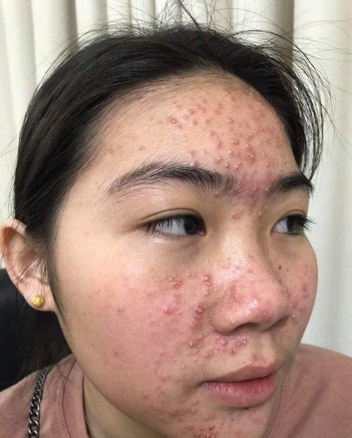 Da-Nhiem-Corticoid-Co-Cuu-Duoc-Khong-Lo-Trinh-Phuc-Hoi-Chuan-Y-Khoa.jpg