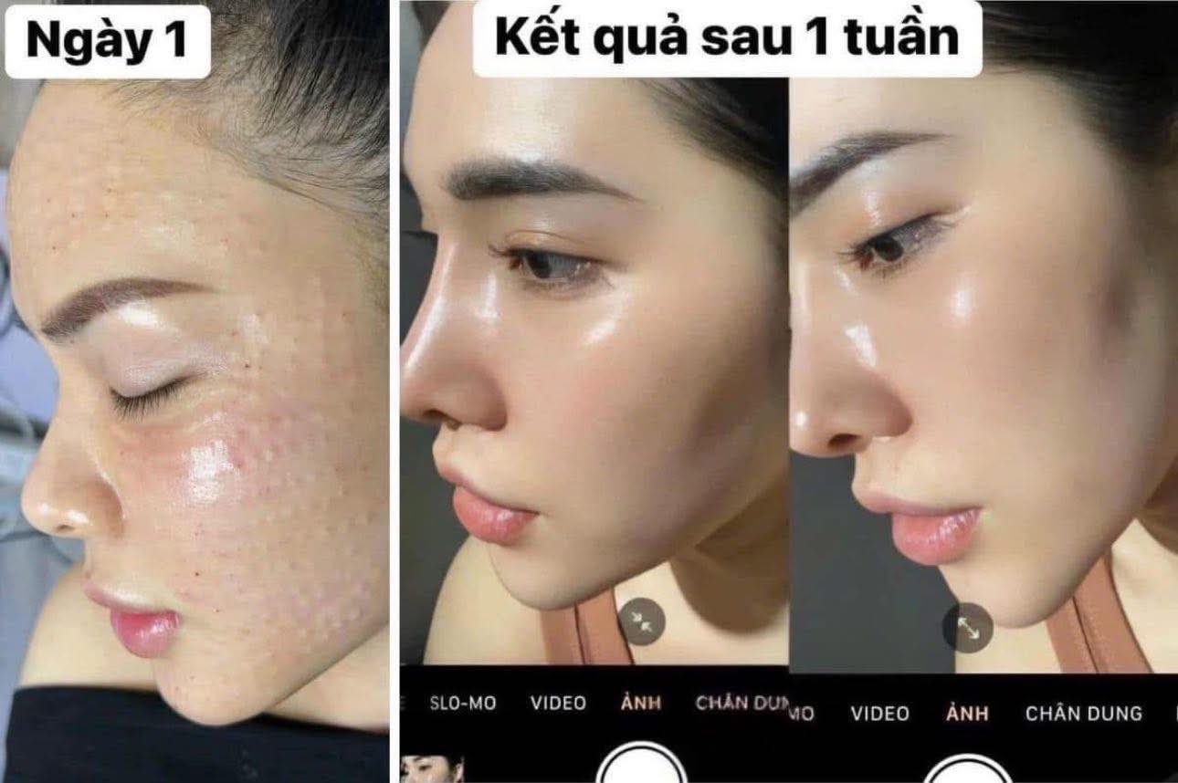 Meso-Trang-Da-La-Gi-Hieu-Qua-Co-Che-Va-Do-An-Toan-1.jpg
