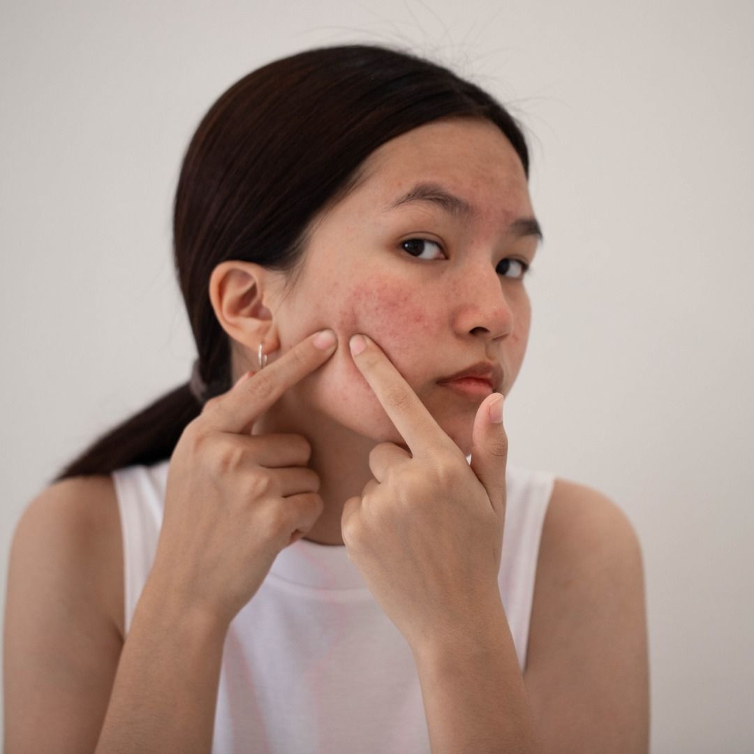 Nặn mụn trứng cá xong bôi gì để nhanh lành, ngừa thâm.jpg