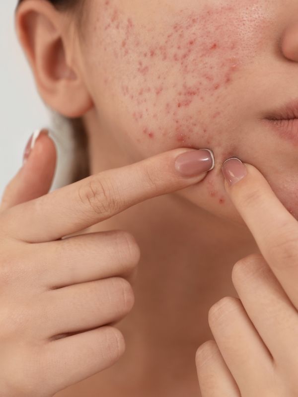 Routine-skincare-cho-da-bi-mun-noi-tiet-1.jpg