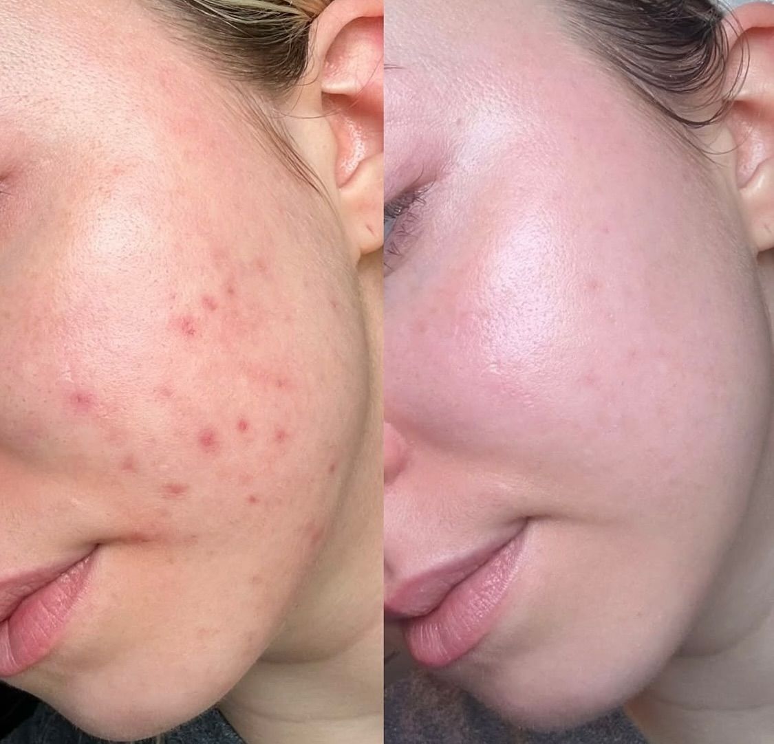 Routine-skincare-cho-da-bi-mun-noi-tiet-2.jpg