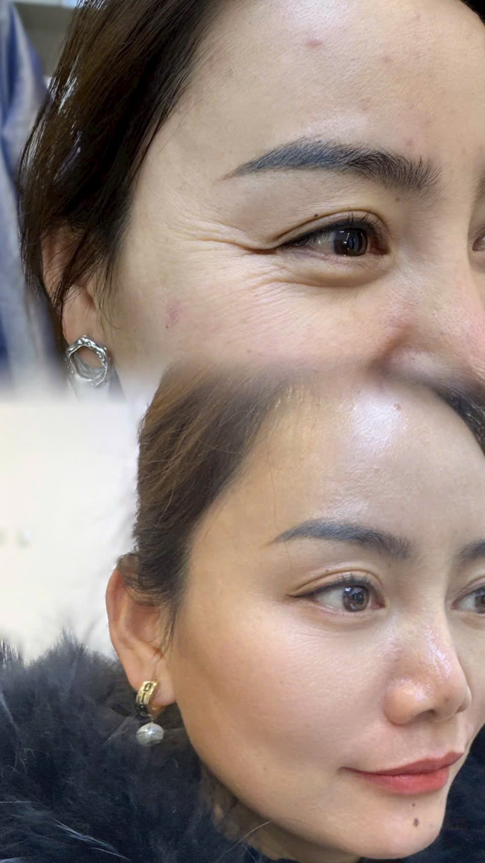 Tiem-Botox-Co-Lam-Mat-Bi-Cung-Khong--2.jpg