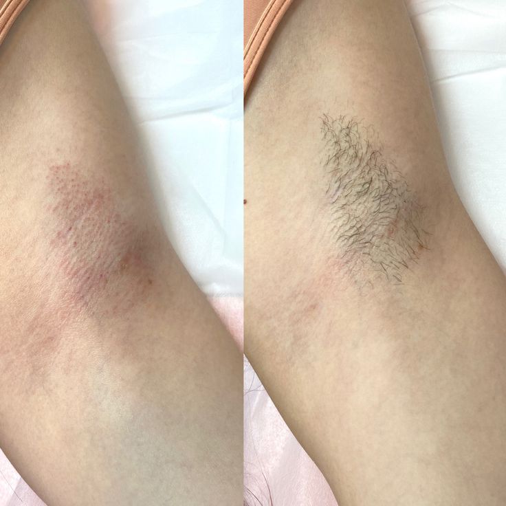 Triet-Long-Nach-Laser-Bao-Nhieu-Lan-Thi-Het--2.jpg