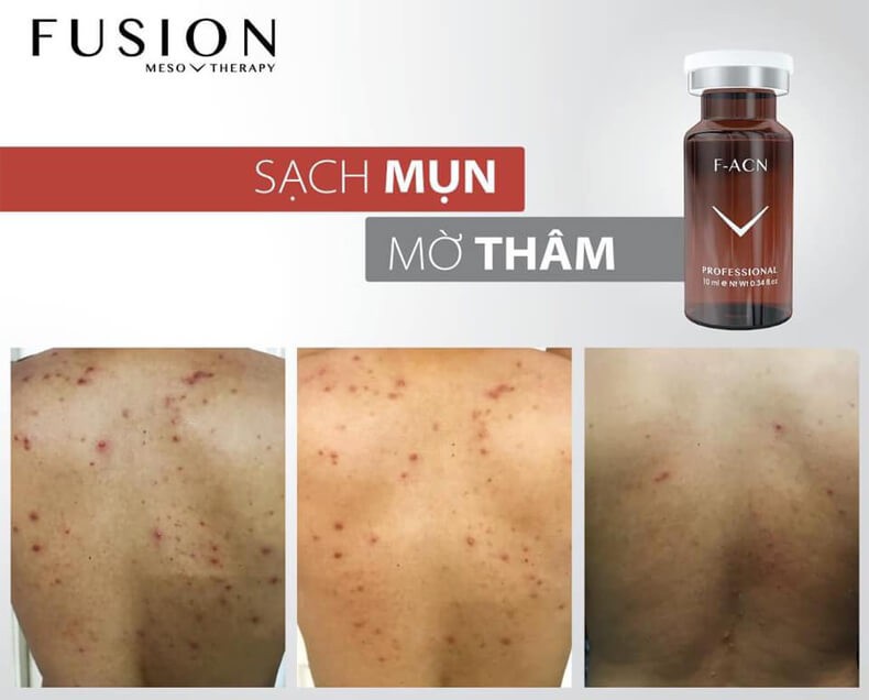 Tinh chất giảm và ngăn ngừa mụn Fusion F - ACN 10ml