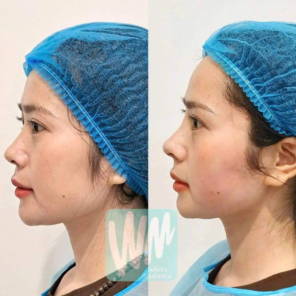 Tinh chất tiêm BAP nâng cơ trẻ hóa da Luhilo hộp 2,5 ml