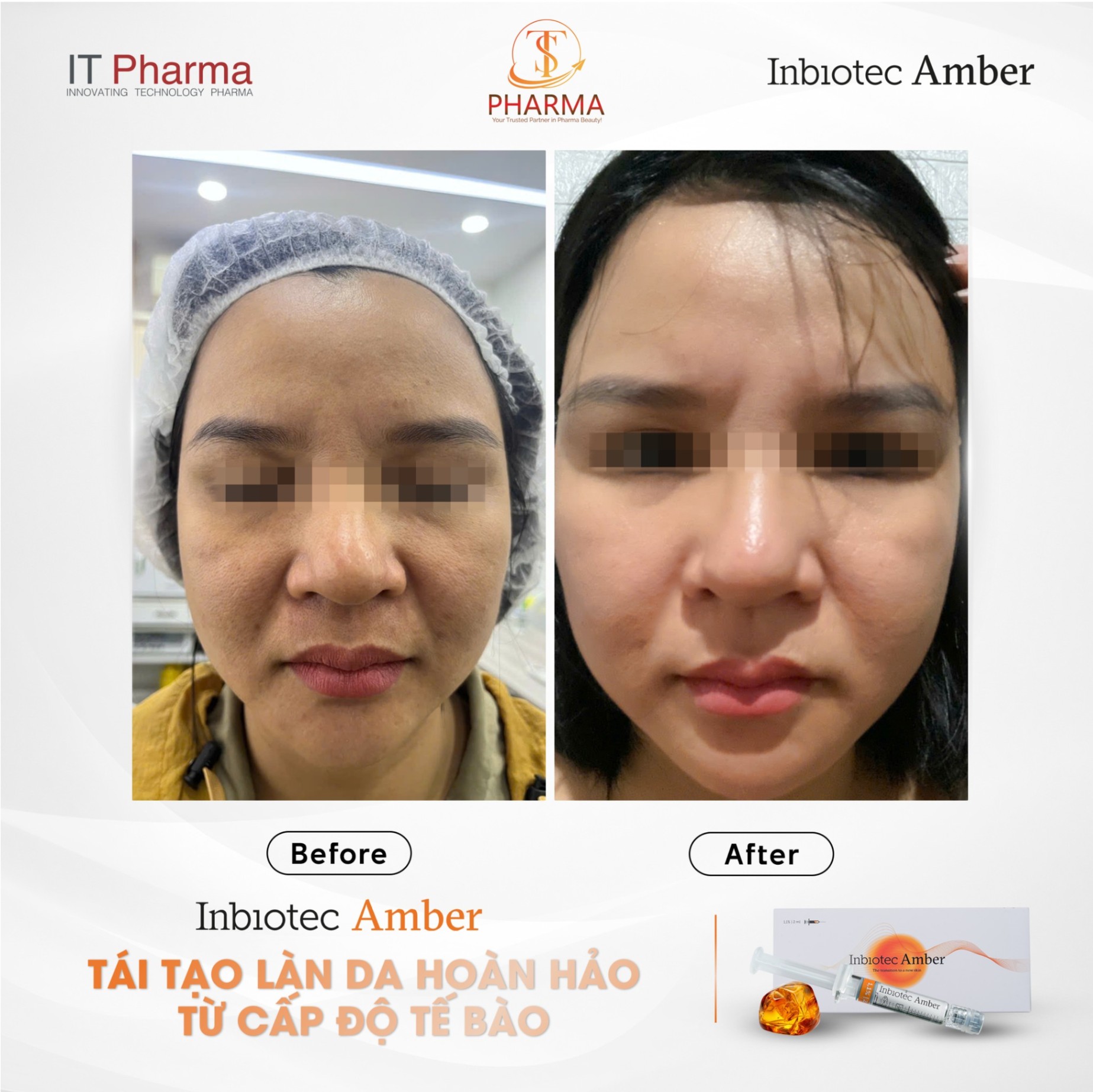 Tinh chất tiêm BAP trẻ hóa da đa tầng Inbiotec Amber hộp 2ml