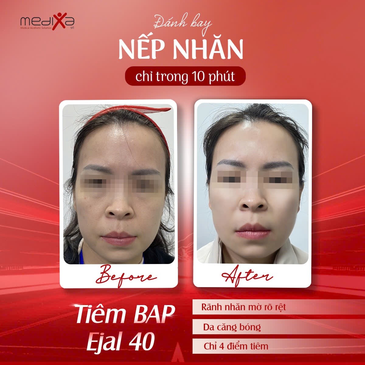 Tinh chất tiêm BAP trẻ hóa da tiên tiến từ Ý Ejal 40 hộp 2ml