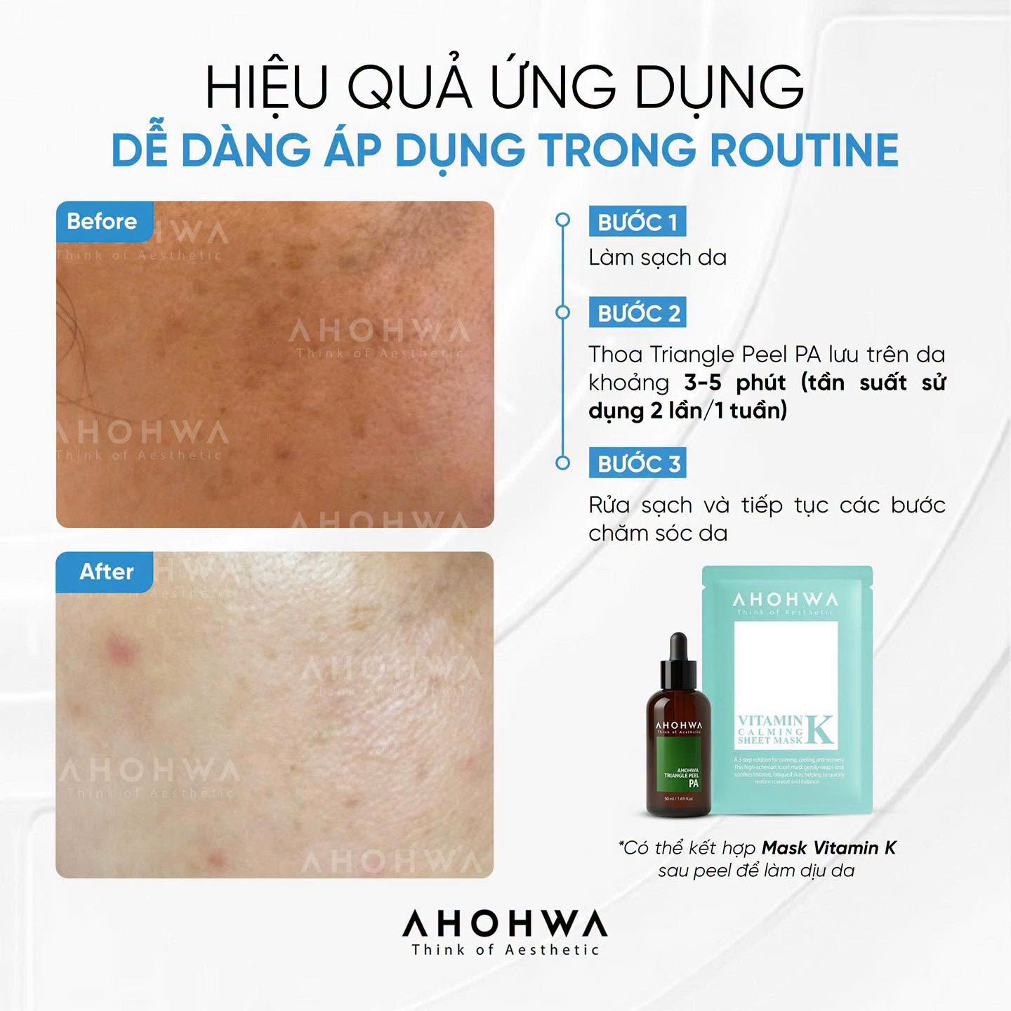 Dung dịch peel dành cho mọi loại da Ahohwa Triangle Peel Pa
