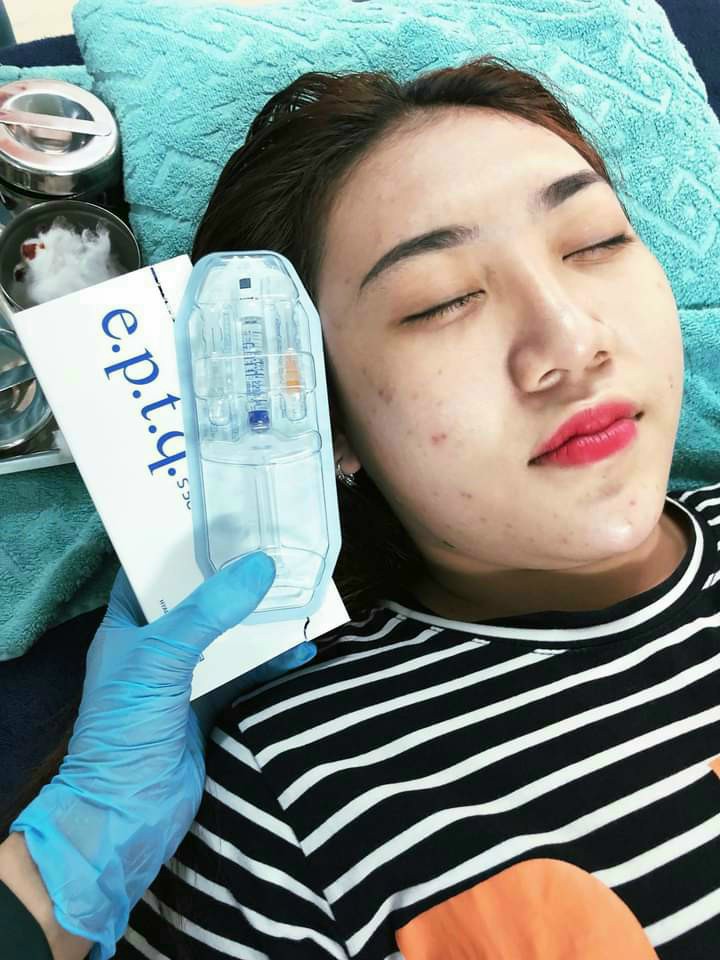 Filler EPTQ S500 (Cứng): Tiêm tạo hình cho Mũi, Cằm, Tiêm làm đầy các vùng rãnh sâu.