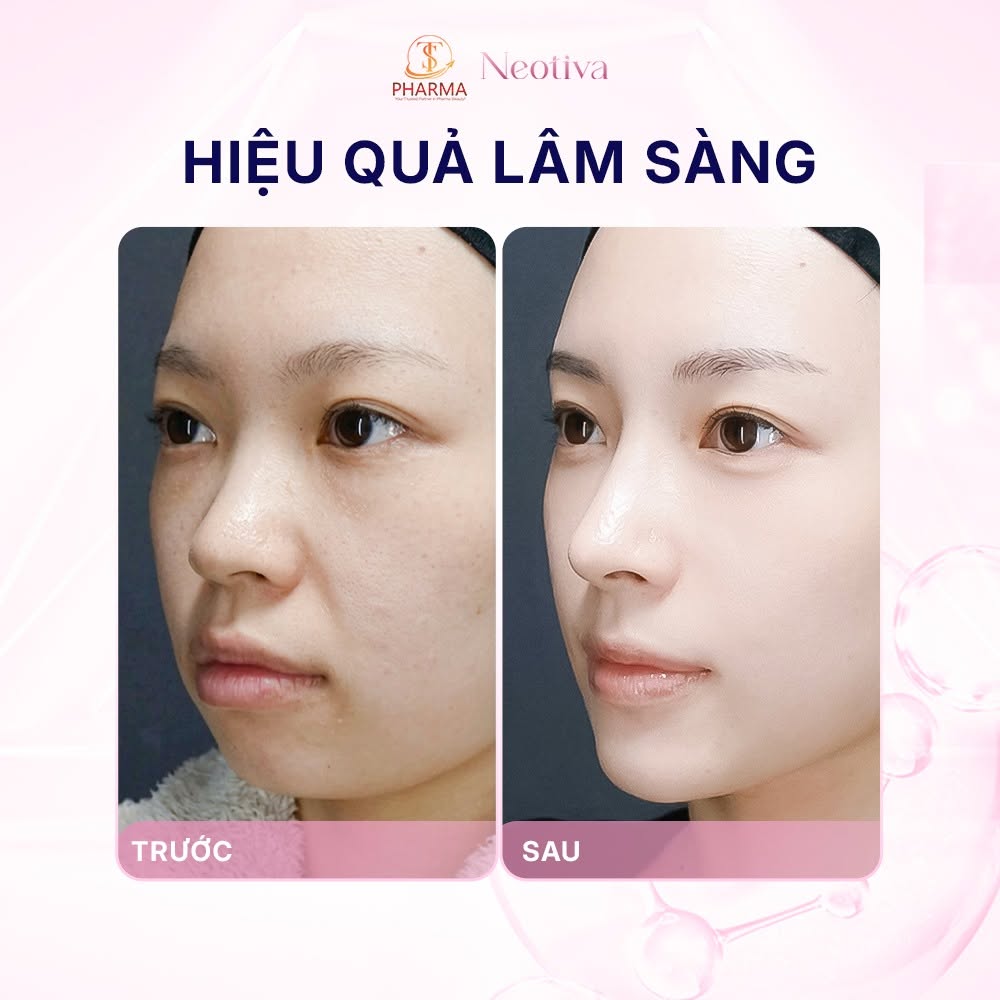 Filler HA Neotiva Hàn Quốc Soft+, Deep+, Volume+, Implant+ – Chất Làm Đầy Hyaluronic Acid Chính Hãng